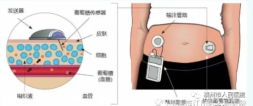 医疗泵什么“糖友”的福音——科外胰岛素泵治疗_https://www.jmylbn.com_新闻资讯_第5张
