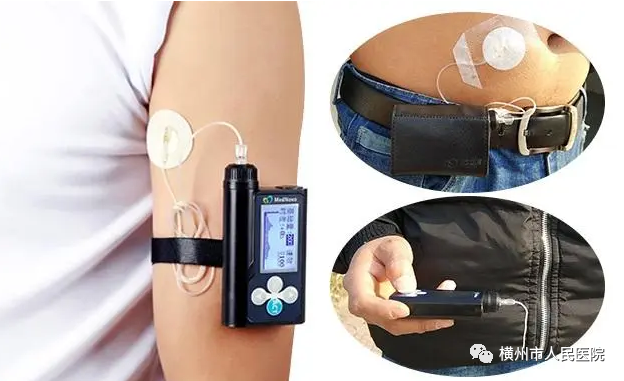 医疗泵什么“糖友”的福音——科外胰岛素泵治疗_https://www.jmylbn.com_新闻资讯_第11张