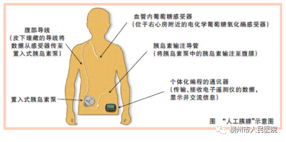 医疗泵什么“糖友”的福音——科外胰岛素泵治疗_https://www.jmylbn.com_新闻资讯_第4张